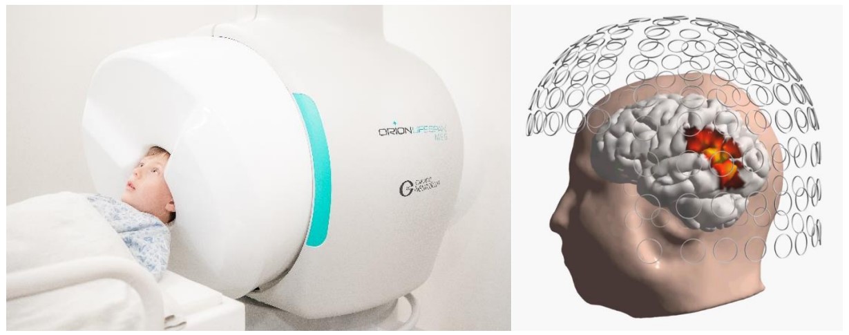 Compumedics Achieves World-First Adult and Child Optimized Recordings ...